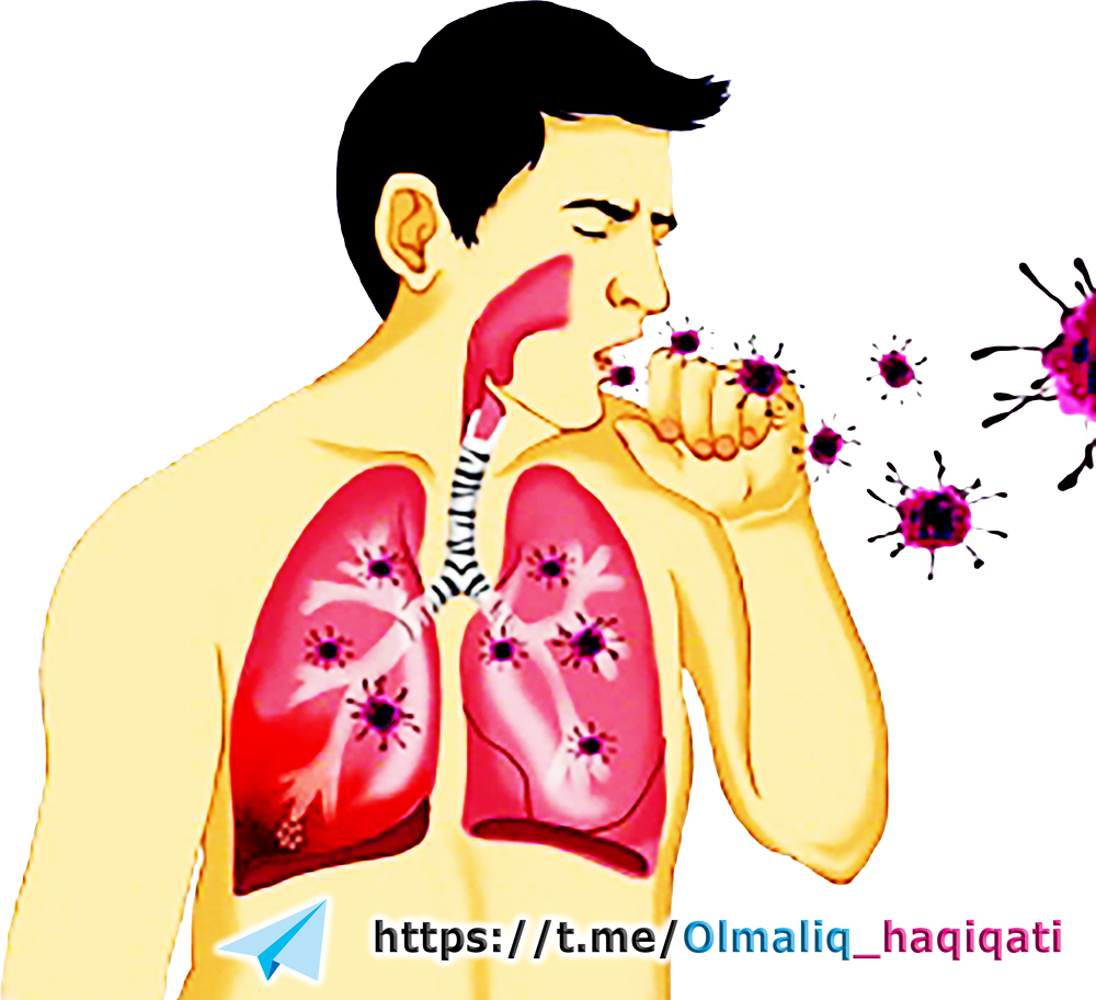 Pulmonary tuberculosis ⋆ WWW.SAVOL-JAVOB.COM 